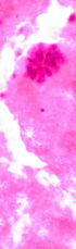 Breast Cancer Patients Have Greatly Benefited from Research